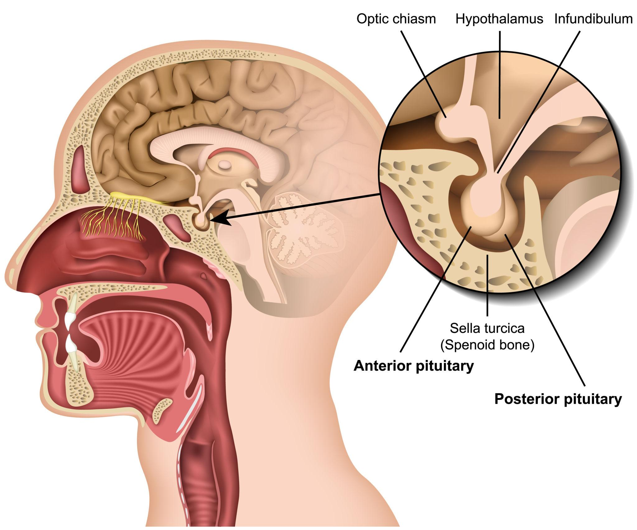 Pituitary adenoma
